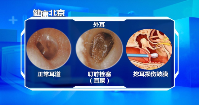 正常内耳道图片图片