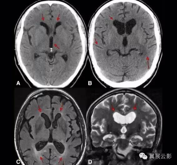 頭痛的病因多樣,如患者出現快速進展的腦實質萎縮和腦白質改變,需要