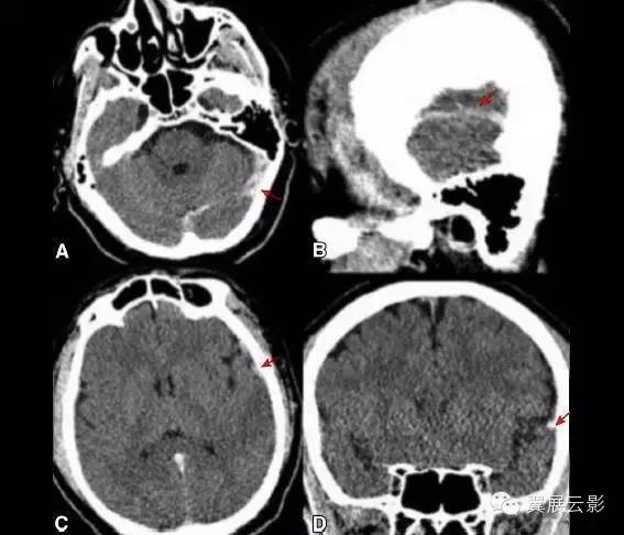 (a)軸位平掃ct示橫竇和乙狀竇高密度影,與硬膜下血腫相類似;(b)矢狀位