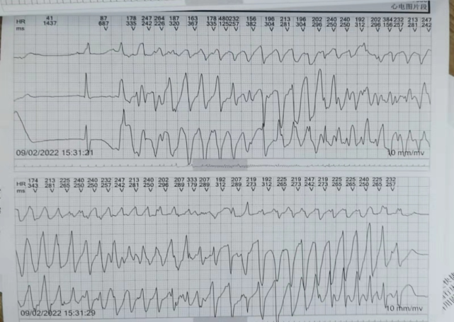 心電圖提示室性心動過速(部分尖端扭轉),室性心動過速(有ront現象),在