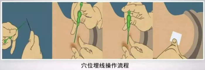 埋线减肥通过特制的器具将可吸收的蛋白线,注入体内相应的穴位,刺激