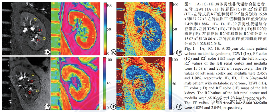 dixonmri和boldmri对成年男性代谢综合征早期肾损伤的定量对比研究