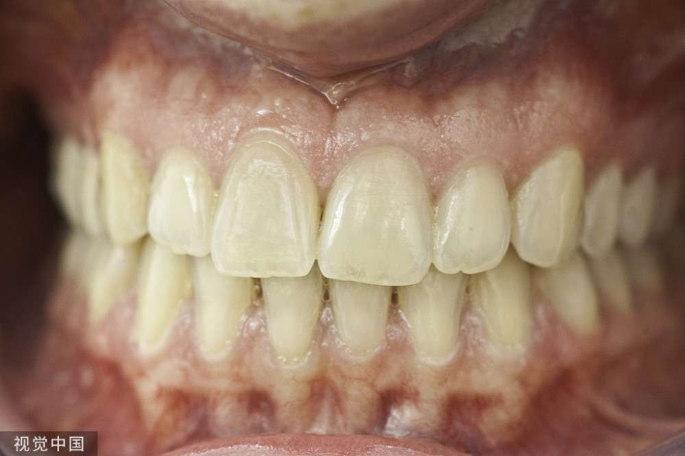 云南中西医结合医院—要怎样治疗牙龈炎_腾讯新闻