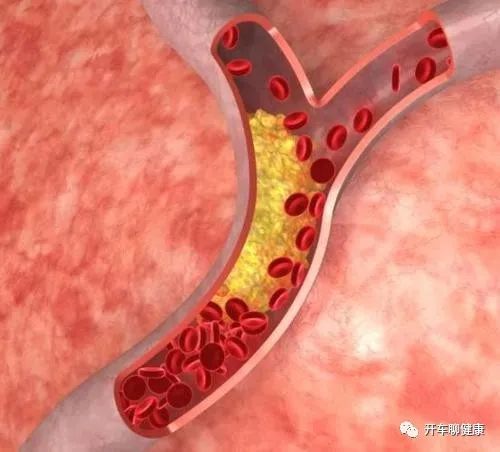 自测血瘀体质,血瘀不仅要活血化瘀,还要益气