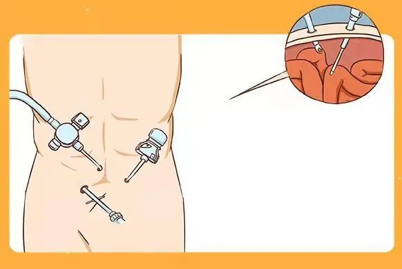 八旬老人因疝气腹股沟鼓出两个小鸭蛋多数老年男性都会中招
