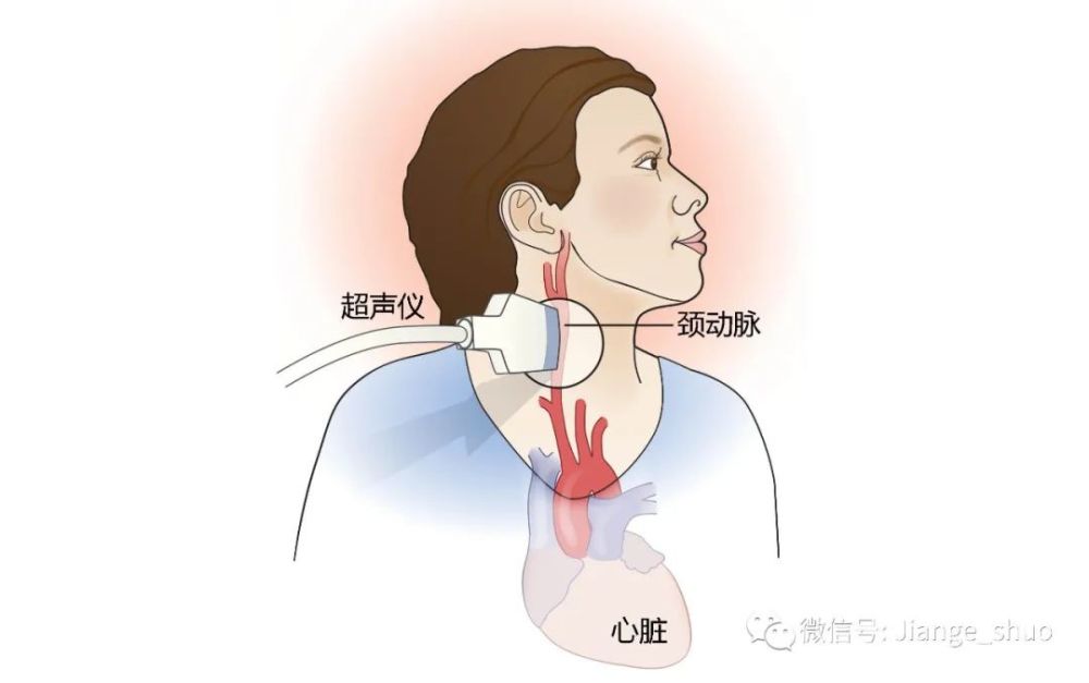 健哥說心臟有聲版頸動脈狹窄冠心病的難兄難弟