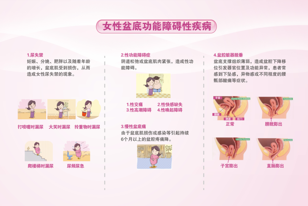 压力性尿失禁(sui),粪失禁,盆腔疼痛以及性功能障碍等