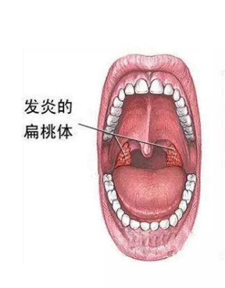 北京首大眼耳鼻喉医院耳鼻喉专家：日常预防小儿扁桃体炎航母战斗群