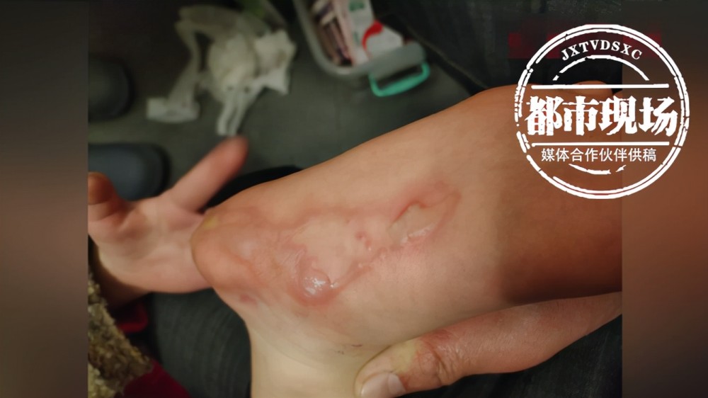 烧坏棉被烫伤娃这是电热毯之过