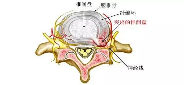 5mm等)查责任椎间盘哪节突出(如:l3-l4,l4-l5,l5-s1等)查突出位置突出