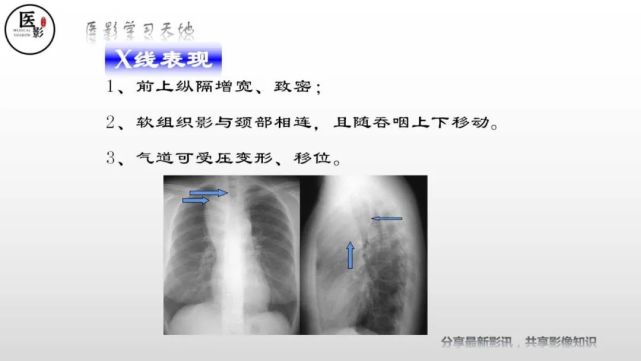 胸內甲狀腺腫