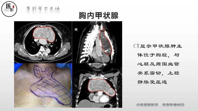 胸內甲狀腺腫