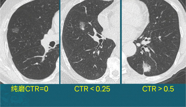 磨玻璃肺結節,ct怎樣區分良性和惡性?哪種結節肺癌風險大?