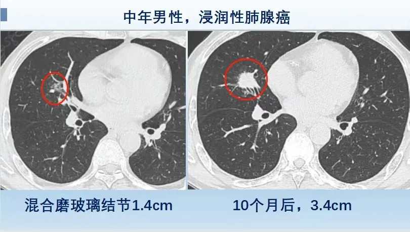 磨玻璃肺结节,ct怎样区分良性和恶性?哪种结节肺癌风险大?_腾讯新闻