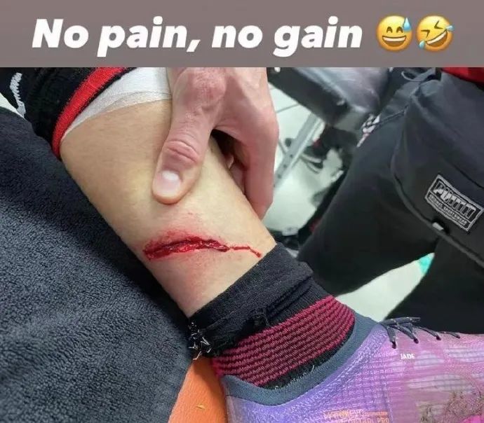 图片丨吉鲁赛后晒受伤部位没有伤痛就没有收获