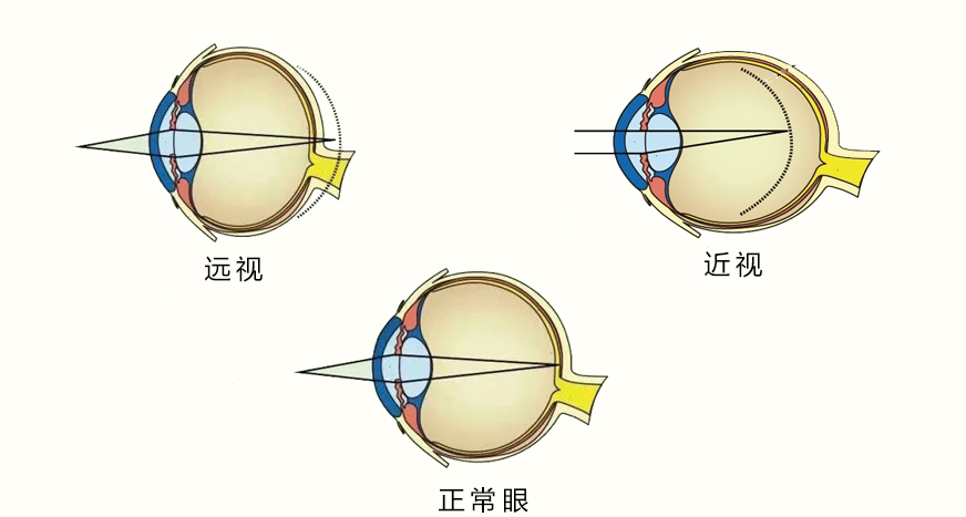 孩子远视储备余额不足离近视就不远了