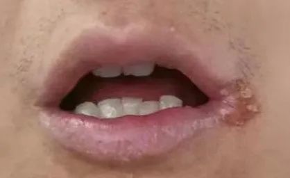烂嘴角到底是个什么病不是上火那么简单