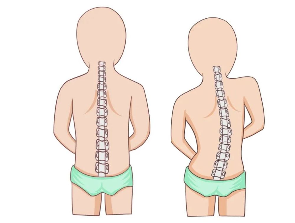 每20个孩子就有1人患病严重影响生长发育医生教您自测法判断脊柱直与