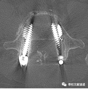 骨科精读椎弓根螺钉断钉取出技巧全都整理好了