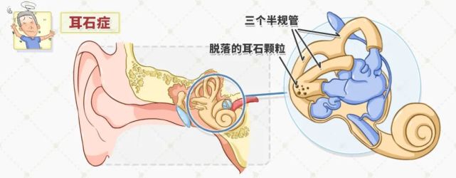 脱落的耳石进入半规管后就会刺激半规管,会让你突然感觉天旋地转,身体