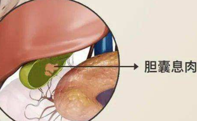 膽囊息肉只能切除藥物治療讓更多人有膽健康生活