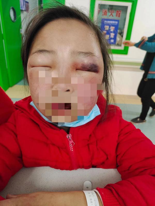 暗红色至紫黑色皮肤软组织肿胀区,双眼睁眼困难,全身可见大量瘀点瘀斑