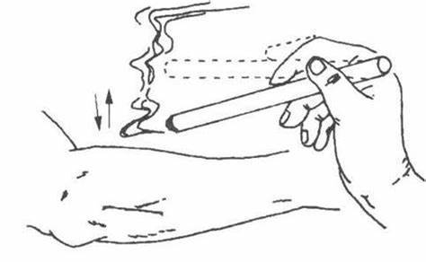 (图片来源于网络)雀啄灸操作时应注意如下事项:(1)要注意艾条上下移动