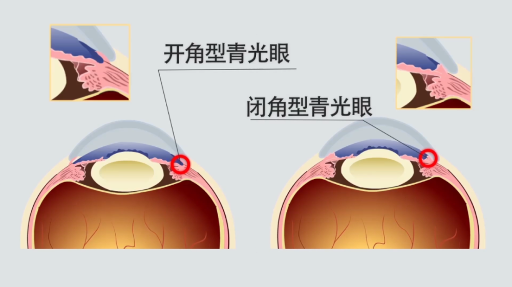 很多患者属于慢性闭角型青光眼,这类患者病情发展缓慢,早期症状不明显