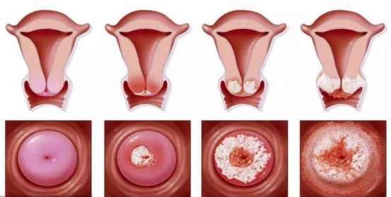 "三八"妇女节健康科普:战胜hpv,从疫苗开始|hpv|疫苗|宫颈癌|hpv 感染
