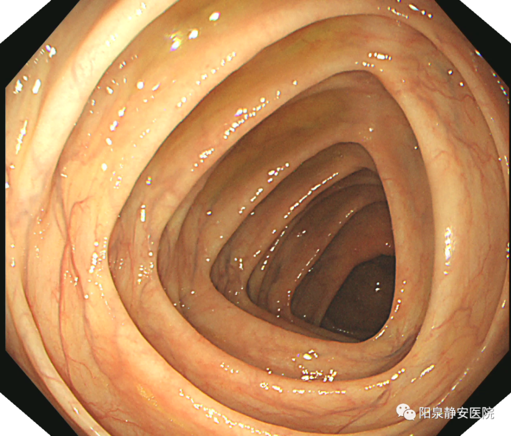 正常人的肠镜图片图片