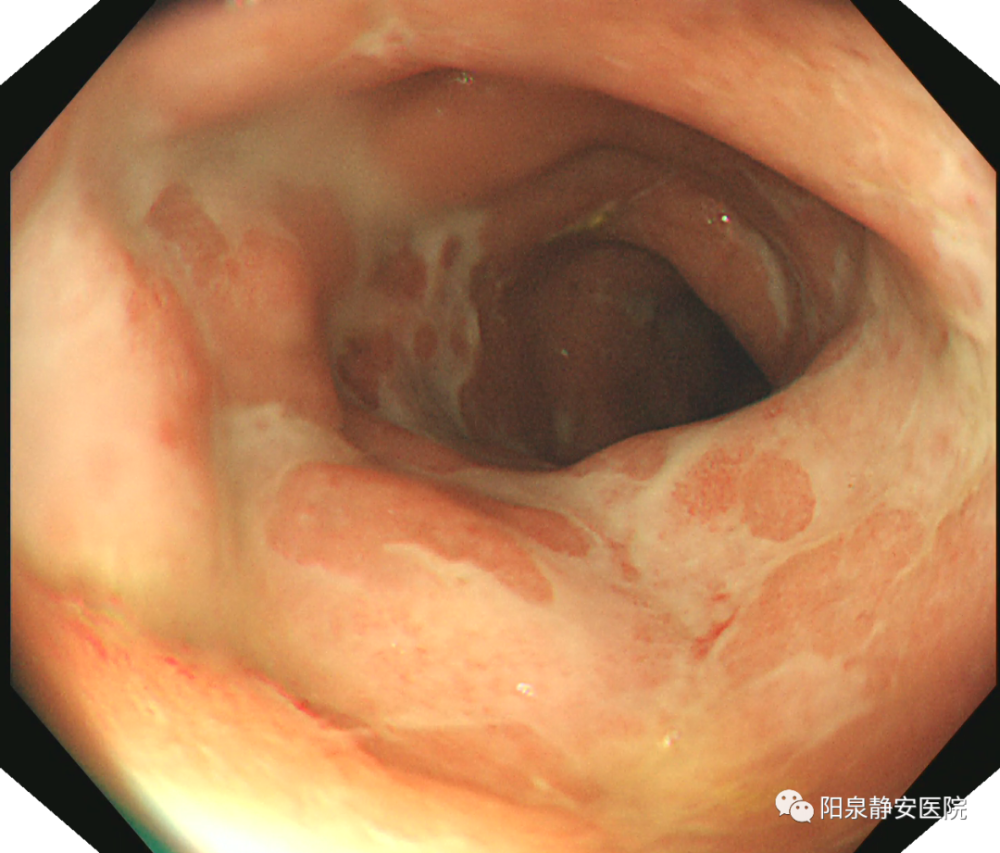 結腸炎痔病結腸癌結腸鏡檢查流程請點擊觀看以下視頻結腸鏡檢查是安全