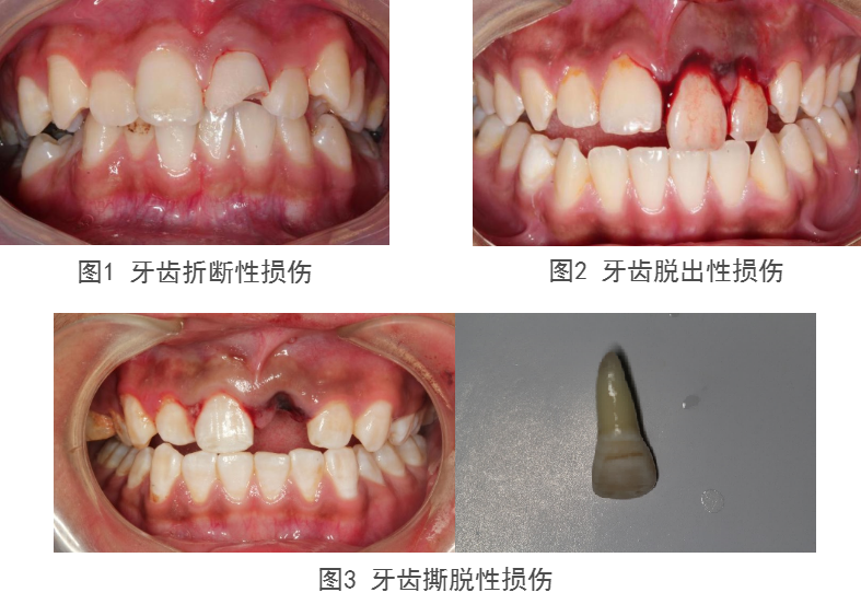 口腔醫學會專欄牙外傷的那些事兒