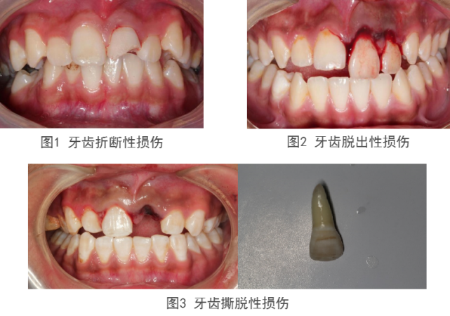 【口腔医学会专栏】牙外伤的 “那些事儿”_腾讯新闻