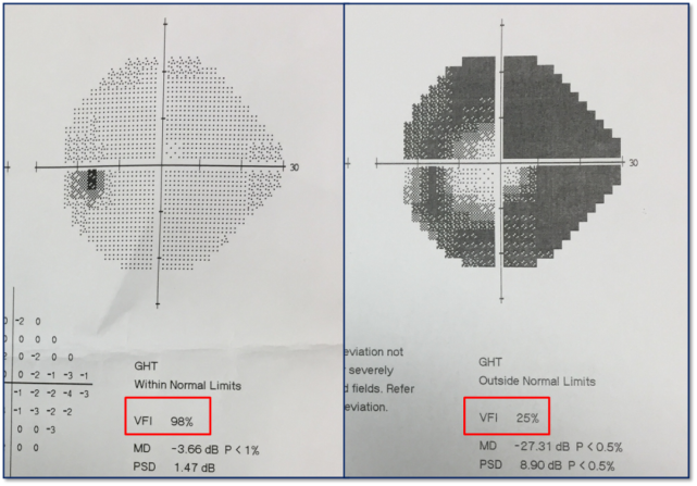 右:杯盘比示意图:即杯子直径占盘子直径的比例,反映视神经损伤程度,杯