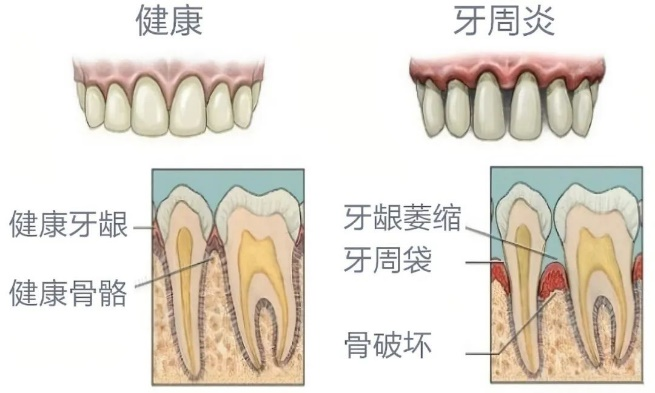 牙周炎是由牙菌斑生物膜引起的牙周組織的慢性感染性疾病,會導致牙周