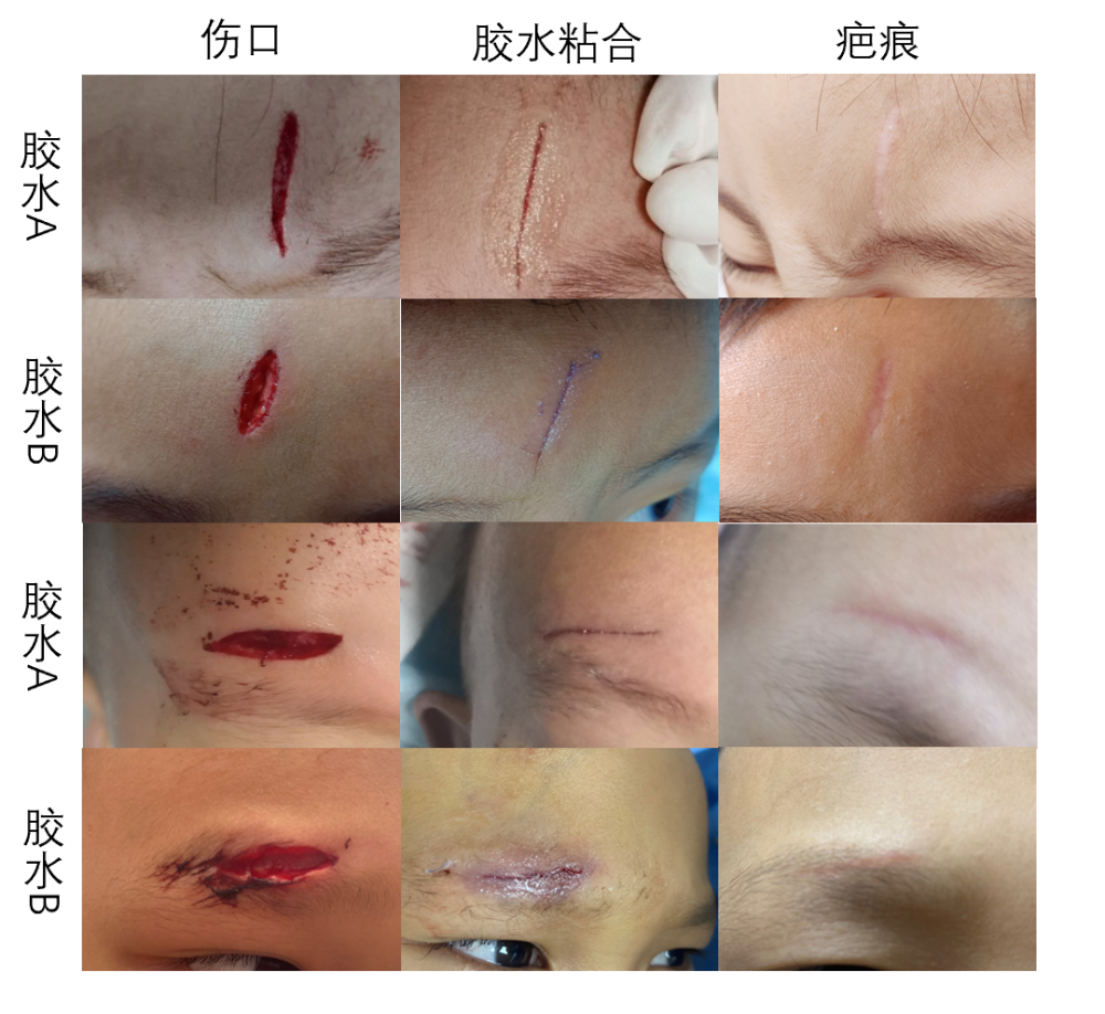 这些伤口不用缝,用"胶水"一涂就好