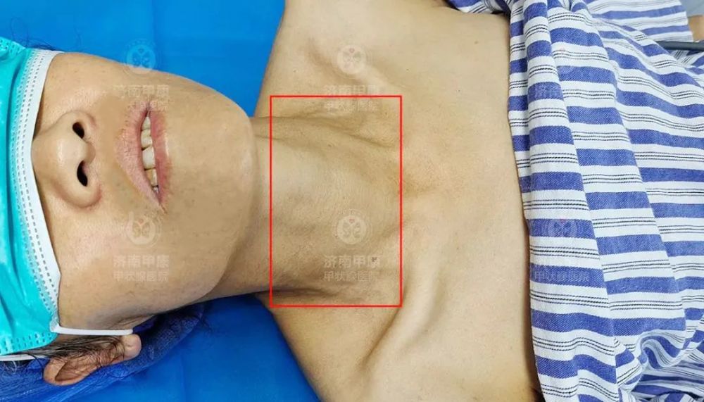 2cm,3.4cm多个甲状腺结节怎么办?主任:不用开刀也能治!_腾讯新闻
