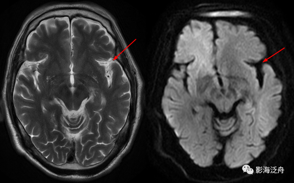 蛛网膜下腔出血——完结篇|精彩不容错过!_腾讯新闻