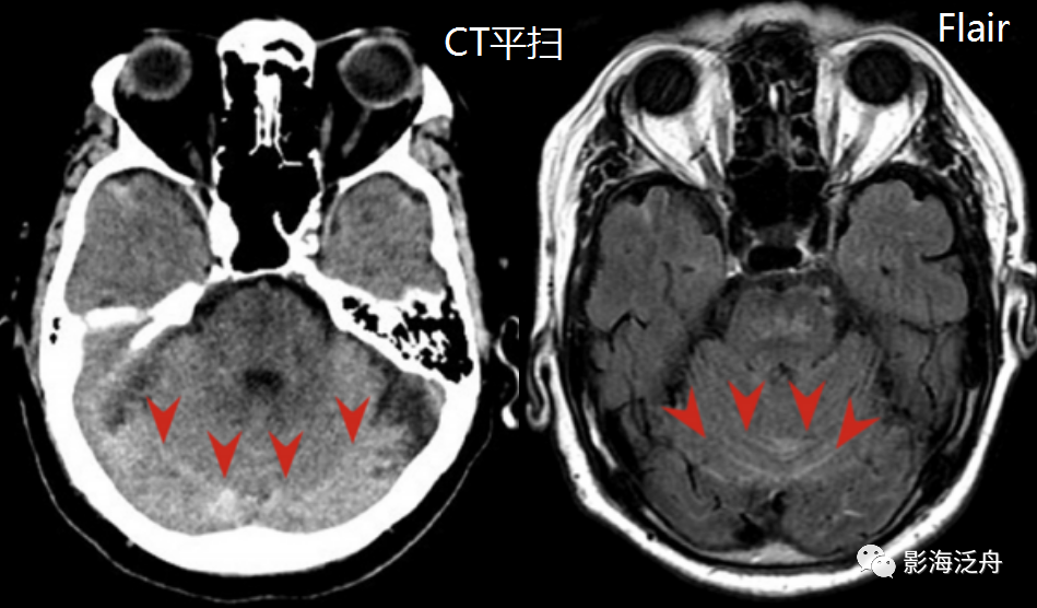 蛛网膜下腔出血——完结篇|精彩不容错过!_腾讯新闻