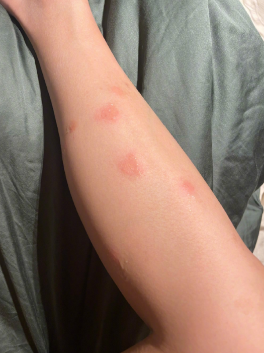 38岁王珞丹独自到海岛游玩被蚊子咬一腿包为脖子刮痧太吓人