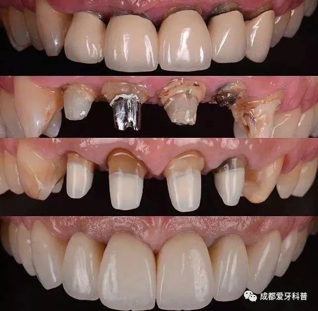 成都牙科醫生任歡科普知識口內有種植牙烤瓷牙牙缺失能矯正牙齒嗎