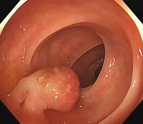 肠镜下观察肠息肉肠镜下观察肠结核病变