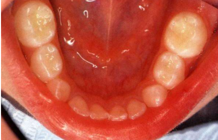 乳牙啥时候掉怎么掉是正常的