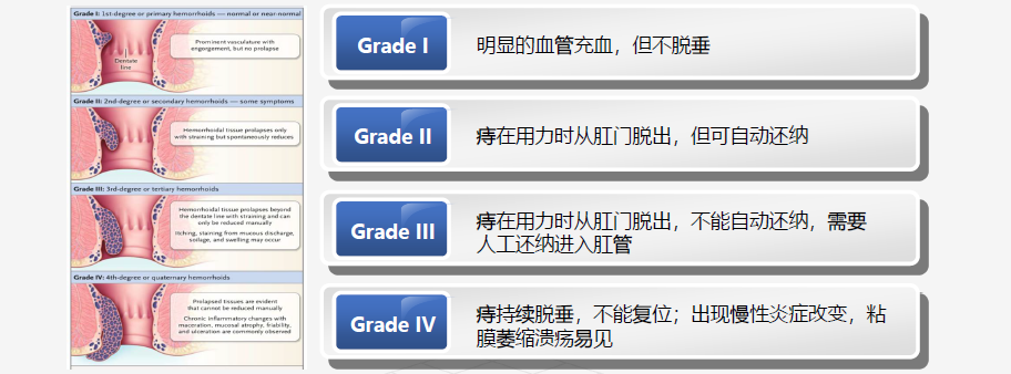 痔疮不用开刀做个肠镜就可以解决真的吗