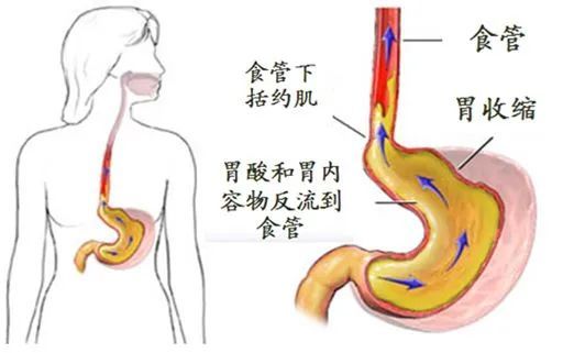 最常見的症狀是胸口灼熱,湧酸感,上腹漲,吞嚥疼痛,嗝氣等.