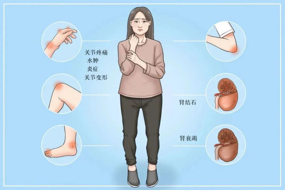 這些關節痛竟是類風溼關節炎的信號燈一定要注意