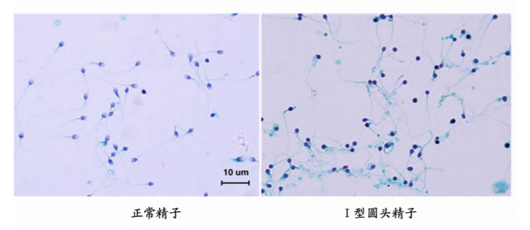 一文总结特殊类畸形精子症的诊疗