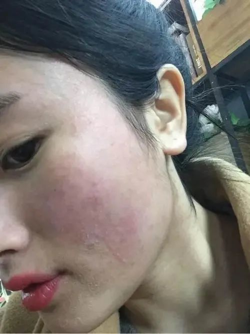 容易受冷风,食物,水质,紫外线,合成纤维,香味,色素等外在环境或物质的