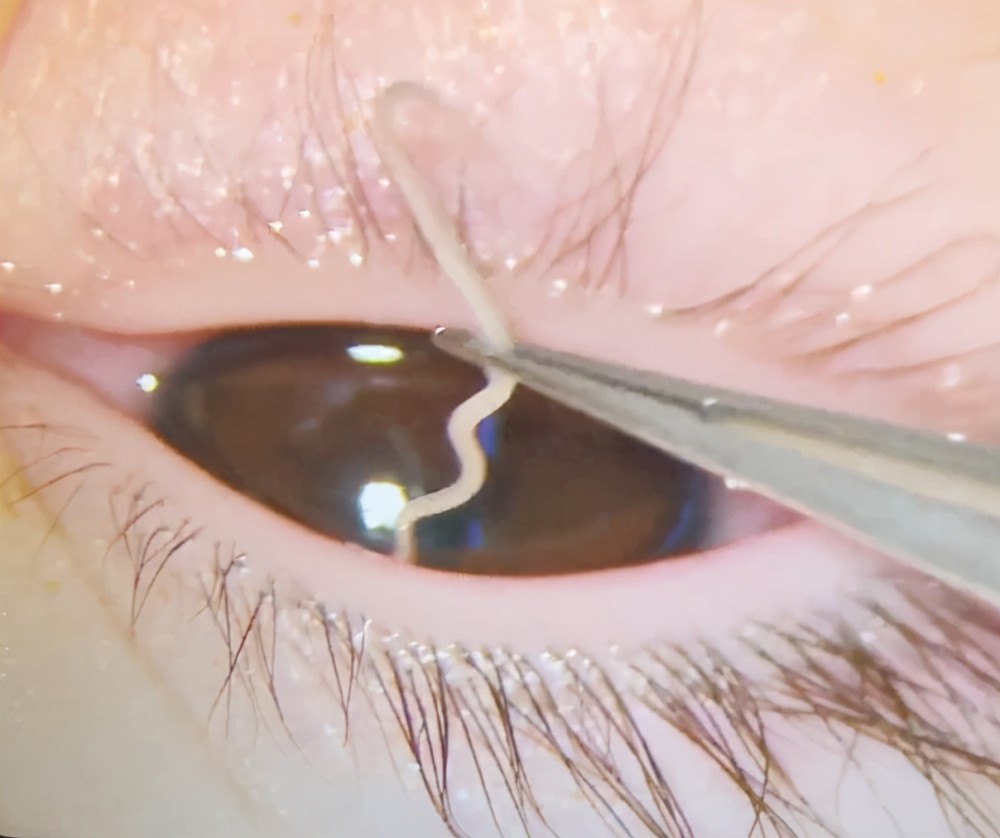 1岁女童眼睛里取出6条活虫妈妈吓得惊叫医生和宠物有关