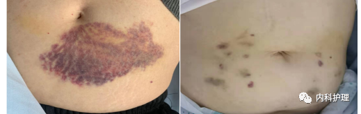 注射低分子肝素钠如何避免皮下出血